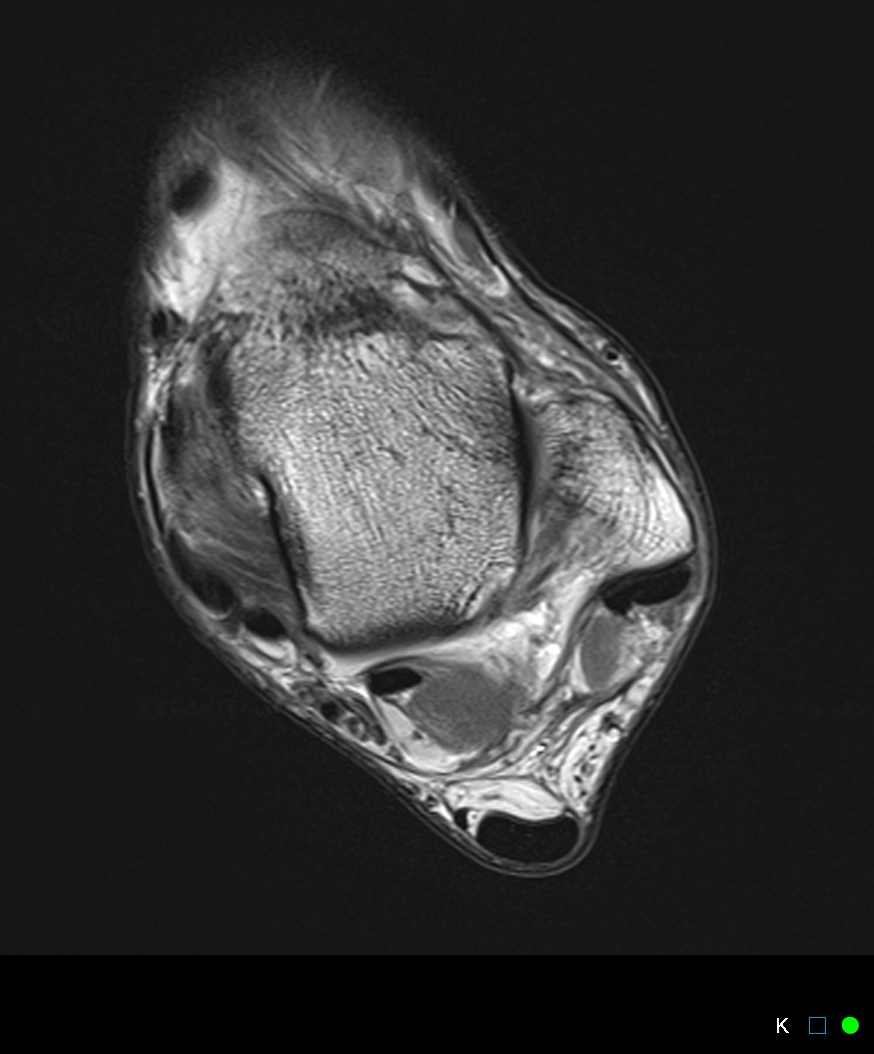 Figure 2 for case SPR tear proximal to fibular insertion